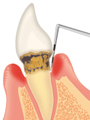 歯茎の溝の深さの測定(イラスト)
