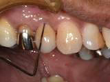 歯茎の溝の深さの測定(写真)
