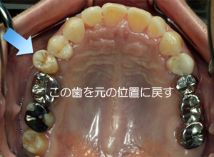 飛び出た歯を矯正治療によって元の位置に戻す